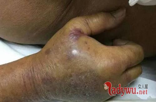广州老人被蟹钳夹伤 截肢后仍不治身亡