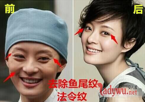 孙俪自曝曾是丑女 坦言“整过容”