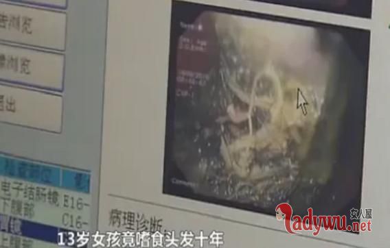 6岁女童患异食癖 引发异食癖的原因有哪些?