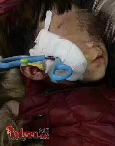 男童剪刀扎入面部
