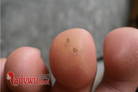 脚上长鸡眼是什么原因