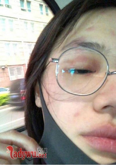 马思纯带状疱疹