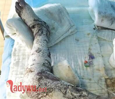男童掉滚烫热水沟