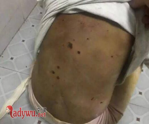 4岁女童疑遭虐待