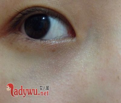 眼部脂肪粒如何消除