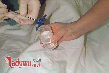 白血病为什么要做骨穿