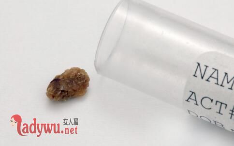 右肾2980颗结石