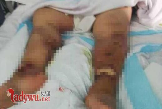 虾尾刺破手指身亡