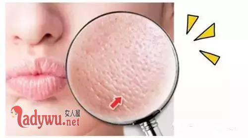 毛孔粗大怎么改善