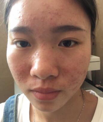 每个人都需要去角质吗