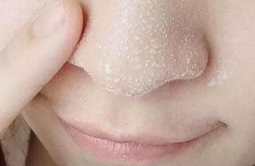 怎么样去除鼻子黑头