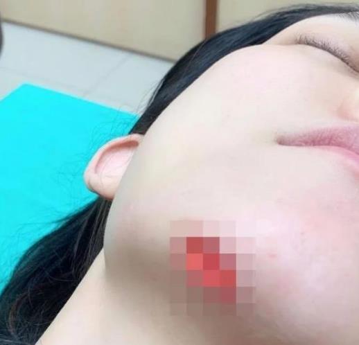 范玮琪下巴缝15针