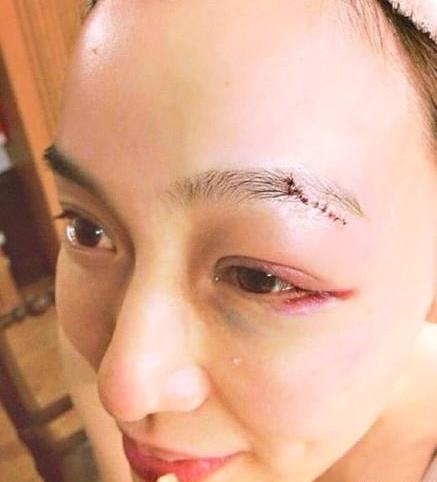 范玮琪下巴缝15针