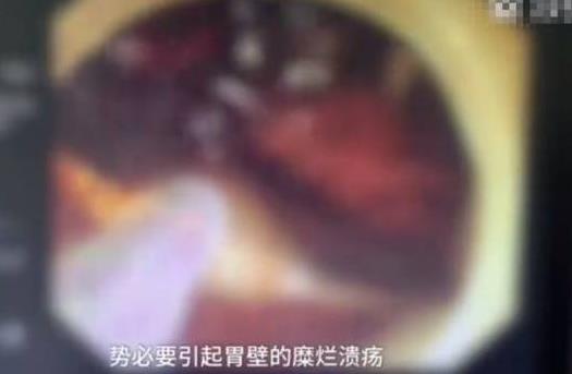 女孩醉酒吞下汤勺