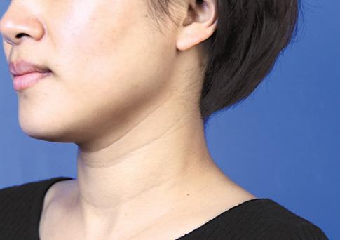 开塞露和维e乳能去颈纹吗