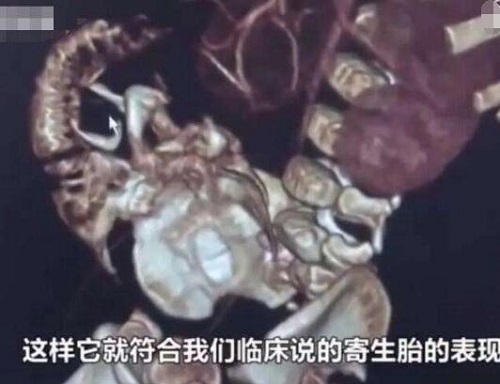 男婴腹中藏寄生胎