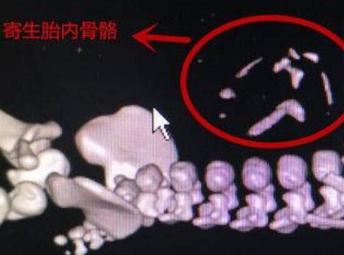男婴腹中藏寄生胎