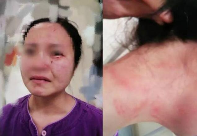 医院回应护士被外籍患者咬伤